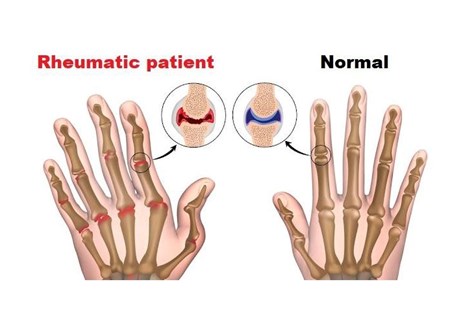روماتیسم و علت روماتیسم چیست؟