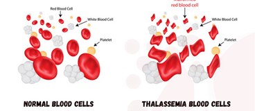 تالاسمی چیست و چه علائمی دارد؟