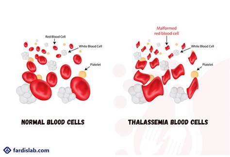 تالاسمی چیست و چه علائمی دارد؟