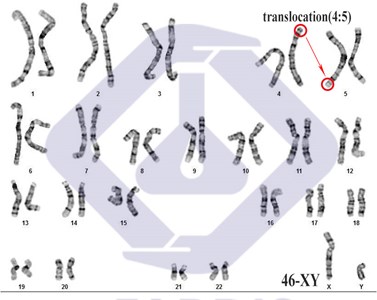 ترنسلوکاسیون کروموزومی