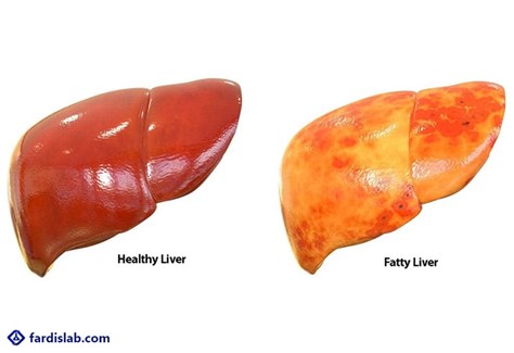 کبد چرب چیست ؟