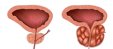 پروستات چیست و چه عوارضی دارد؟