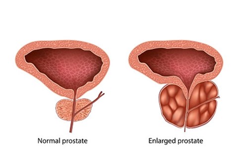 پروستات چیست و چه عوارضی دارد؟