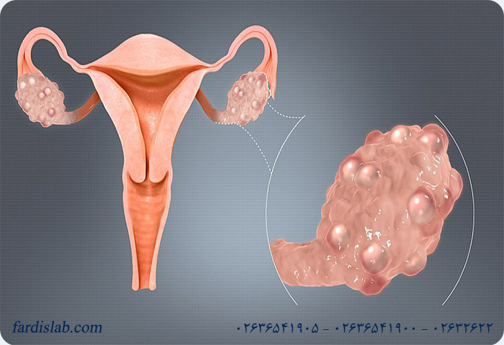 ویژگی های تخمدان پلی کیستیک