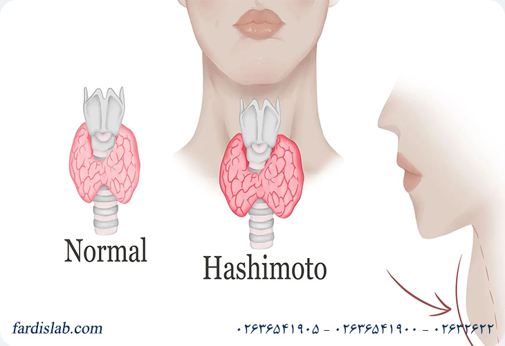 هاشیموتو چیست؟