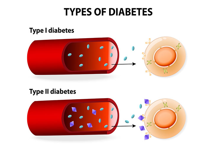 انواع دیابت