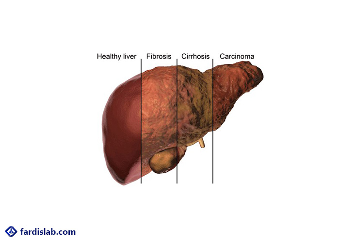انواع کبد چرب کدامند؟ 