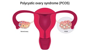 سندرم تخمدان پلی کیستیک چیست؟