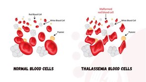 تالاسمی چیست و چه علائمی دارد؟
