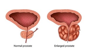 پروستات چیست و چه عوارضی دارد؟