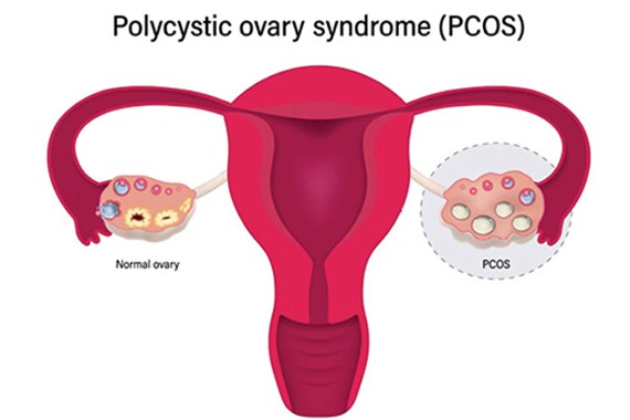 سندرم تخمدان پلی کیستیک چیست؟