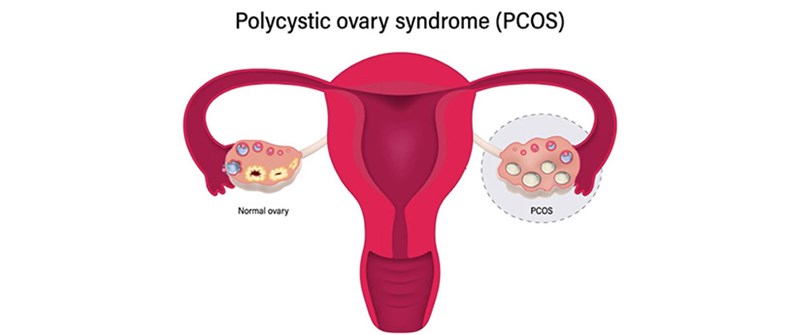 سندرم تخمدان پلی کیستیک چیست؟