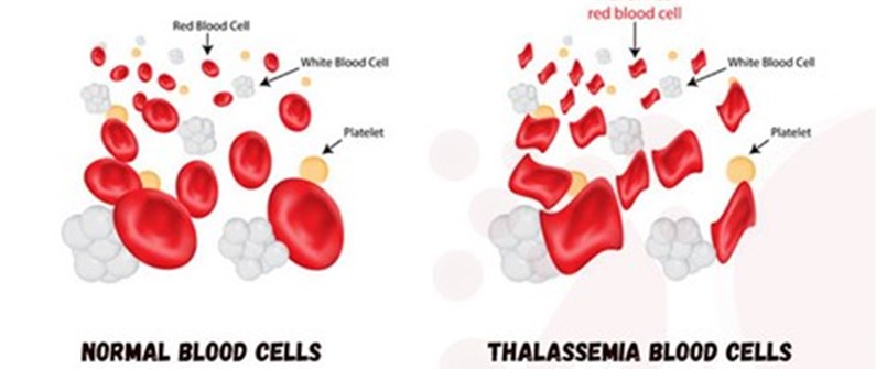 تالاسمی چیست و چه علائمی دارد؟