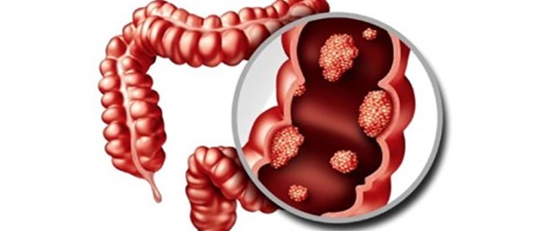 نكاتی در رابطه با سرطان كولون (Colon Cancer )